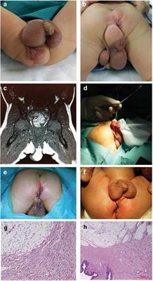 Case Report: Congenital Perineal Lipoma Associated With Additional External Genitalia Anomalies